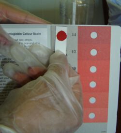Haemoglobin colour scale – Anemia test KIt Refill strips