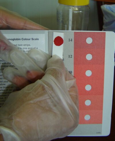 Haemoglobin colour scale – Anemia test KIt Refill strips